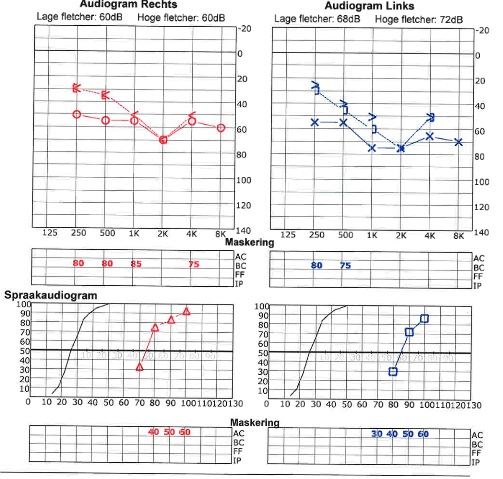 Audiogram Ties